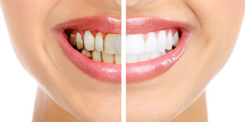 Nguyên nhân và các phương pháp khắc phục khi răng bị xỉn màu